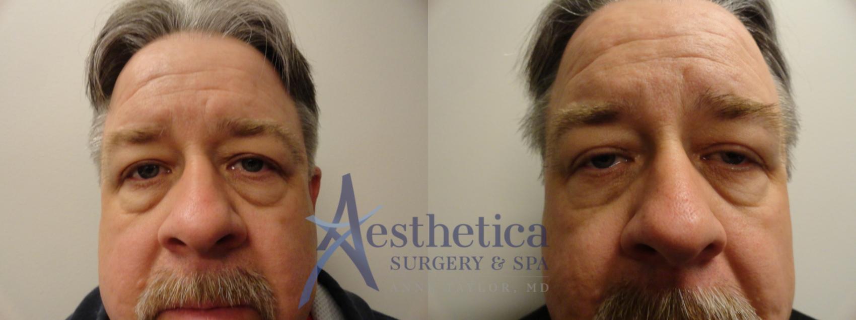 Blepharoplasty (Eyelid Surgery) Case 853 Before & After Front | Columbus, OH | Aesthetica Surgery & Spa