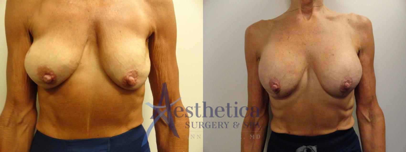 Breast Augmentation Revision Case 859 Before & After Front | Columbus, OH | Aesthetica Surgery & Spa
