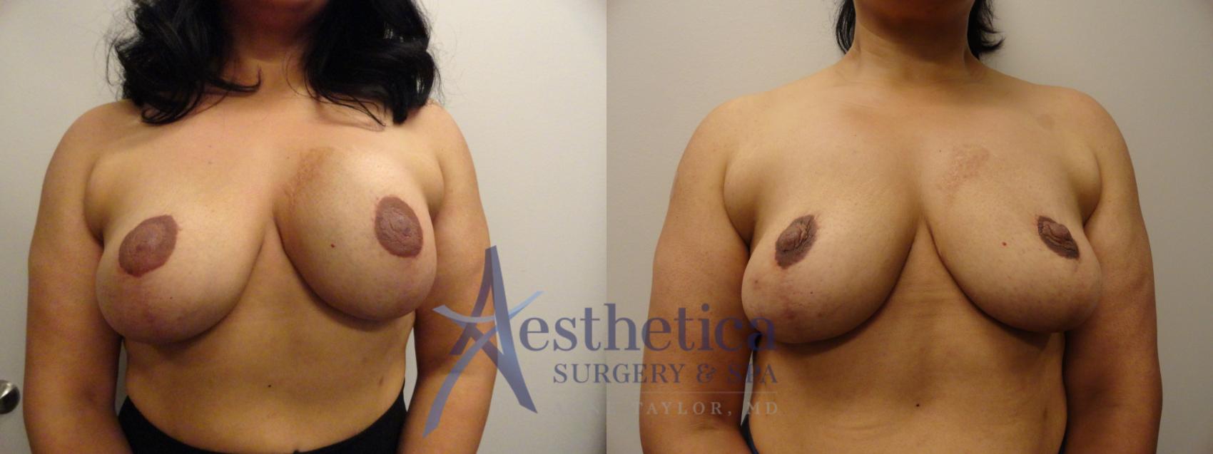 Breast Implant Removal Case 848 Before & After Front | Columbus, OH | Aesthetica Surgery & Spa