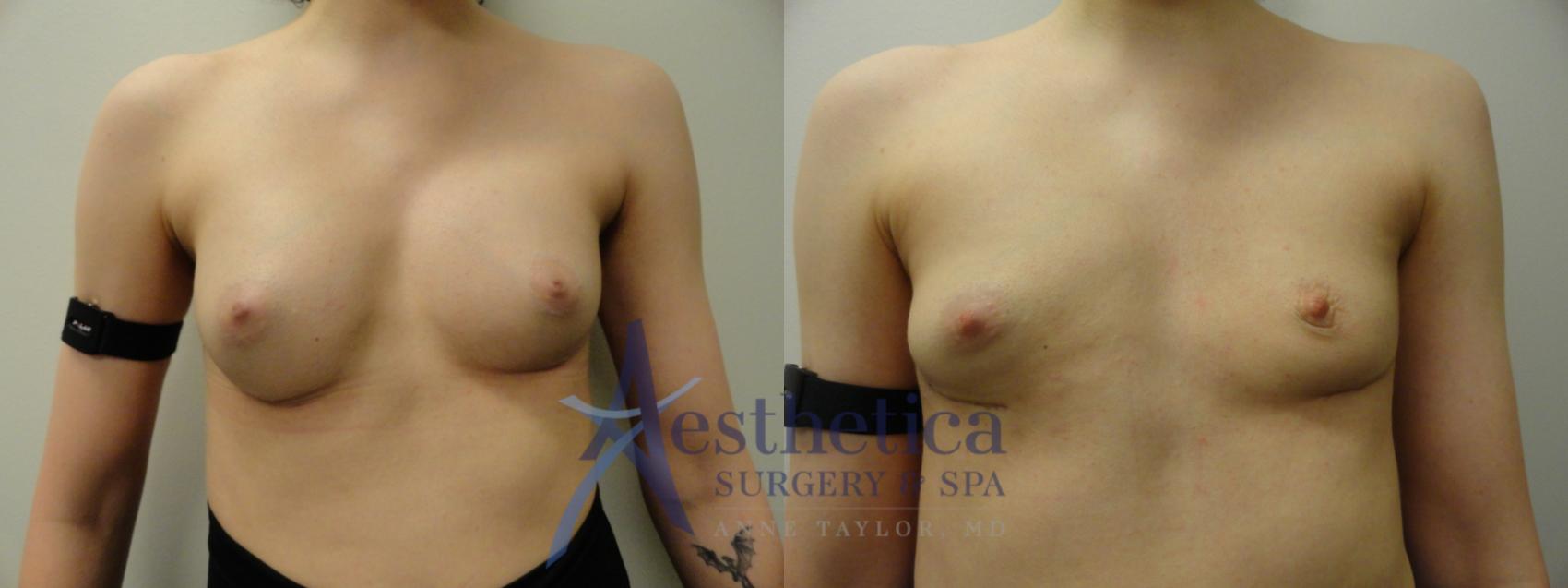 Breast Implant Removal Case 852 Before & After Front | Columbus, OH | Aesthetica Surgery & Spa