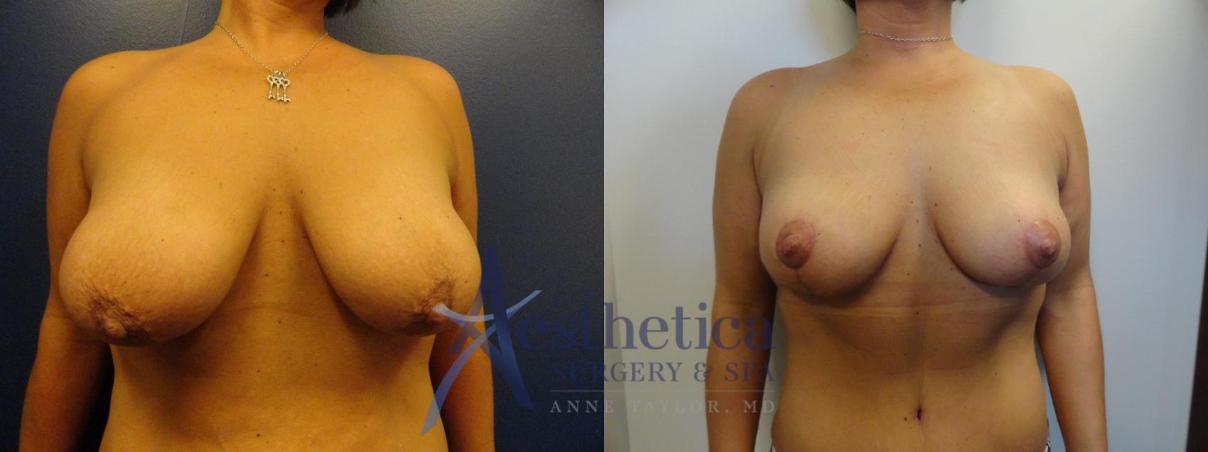 Breast Lift Case 25 Before & After View #1 | Columbus, OH | Aesthetica Surgery & Spa