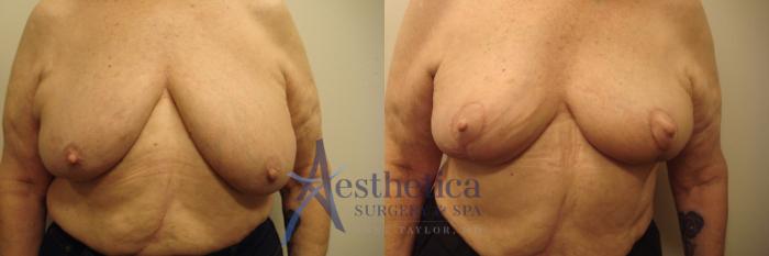 Breast Lift Case 512 Before & After Front | Columbus, OH | Aesthetica Surgery & Spa