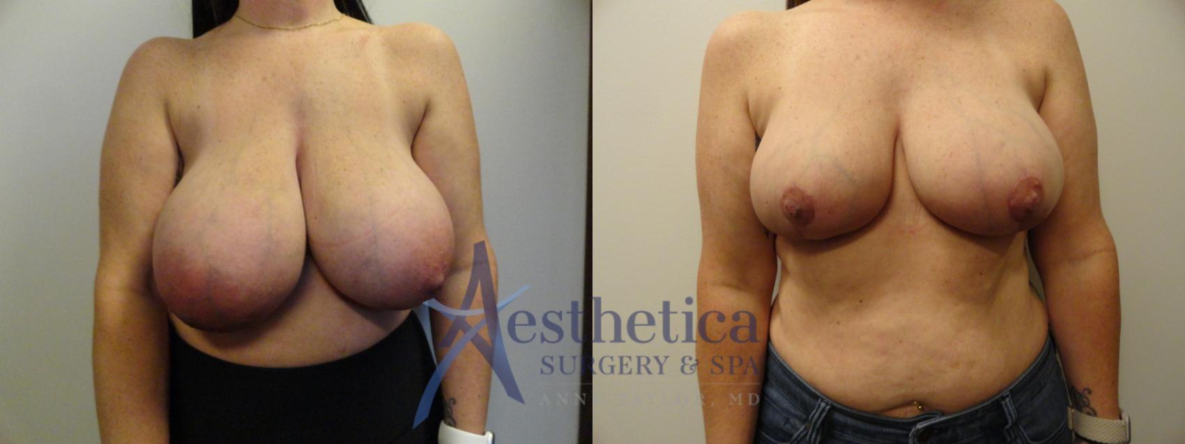 Breast Reduction Case 851 Before & After Front | Columbus, OH | Aesthetica Surgery & Spa