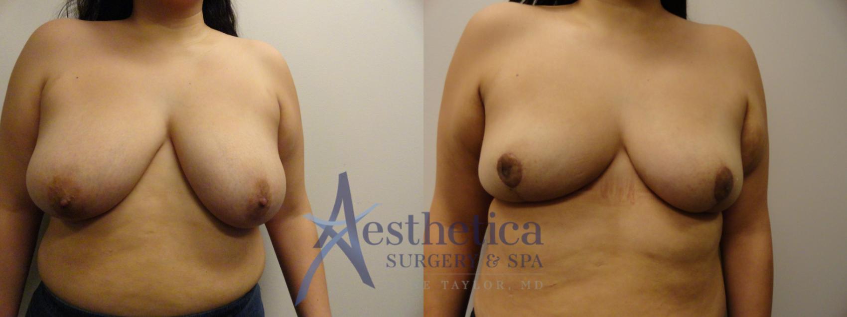 Breast Reduction Case 856 Before & After Front | Columbus, OH | Aesthetica Surgery & Spa