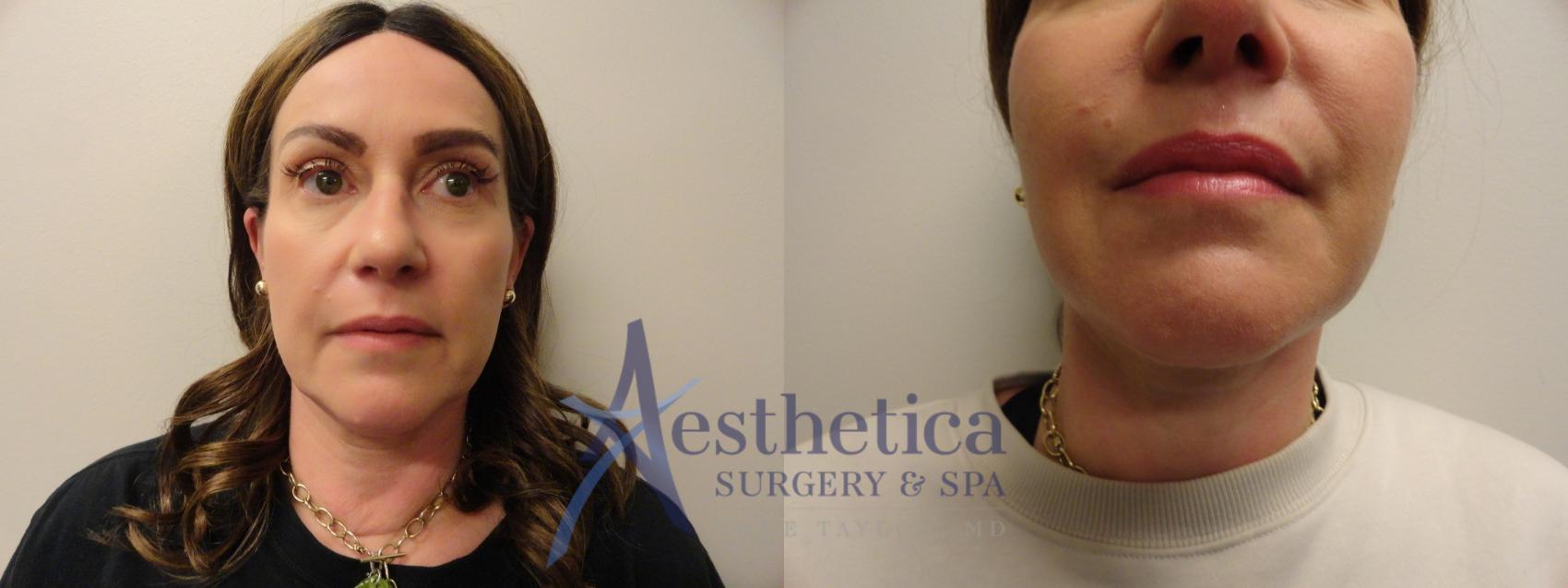 Facelift Case 858 Before & After Front | Columbus, OH | Aesthetica Surgery & Spa