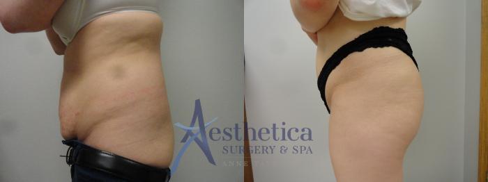 Liposuction Case 47 Before & After View #1 | Columbus, OH | Aesthetica Surgery & Spa
