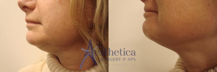 Liposuction Case 495 Before & After Left Side | Columbus, OH | Aesthetica Surgery & Spa