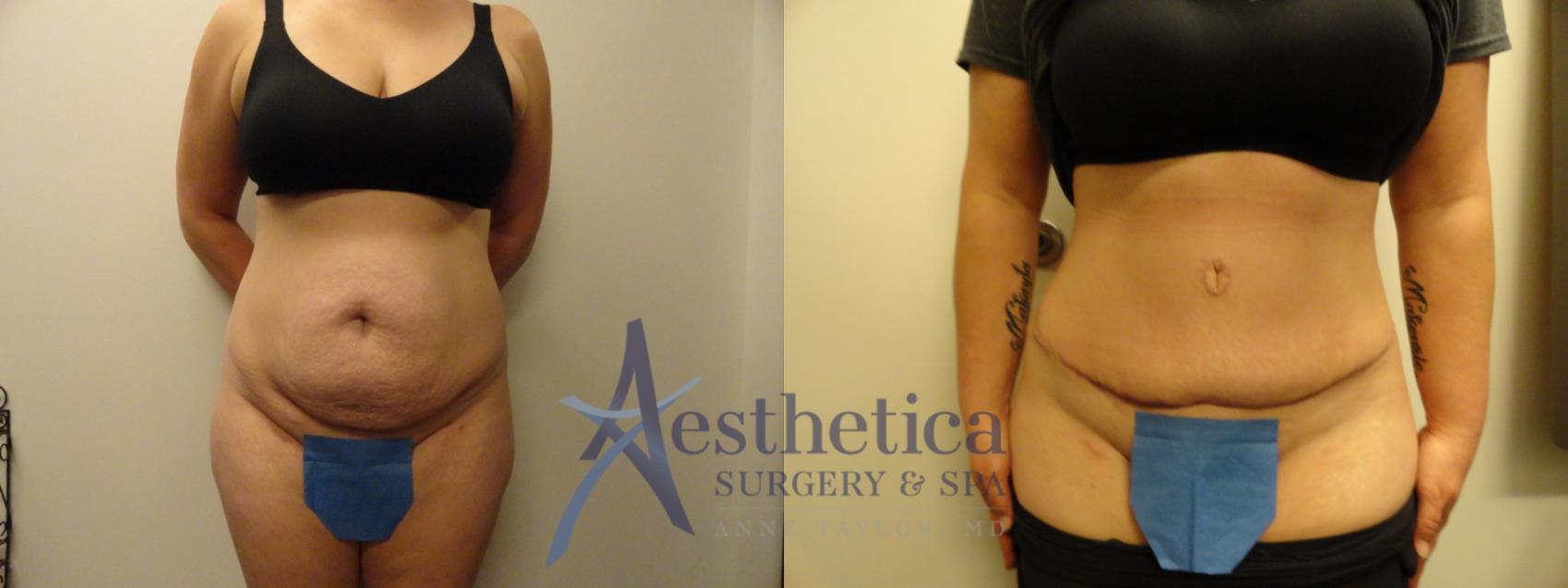 Tummy Tuck Case 850 Before & After Front | Columbus, OH | Aesthetica Surgery & Spa