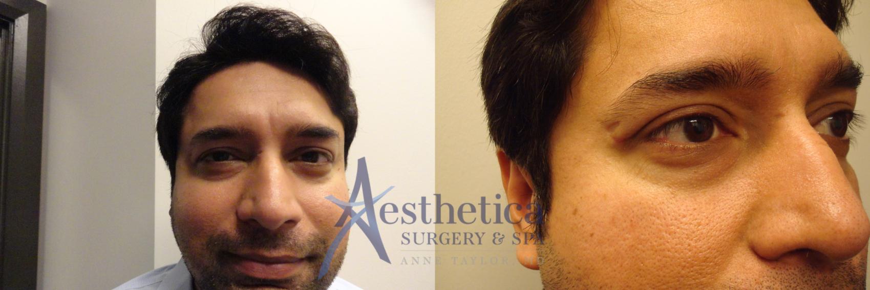 Eyelid Surgery for Men Case 355 Before & After View #1 | Columbus, OH | Aesthetica Surgery & Spa