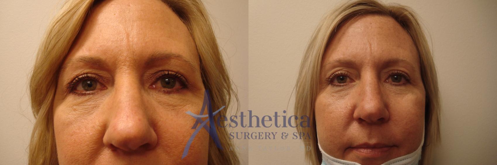 Blepharoplasty (Eyelid Surgery) Case 361 Before & After View #1 | Worthington, OH | Aesthetica Surgery & Spa