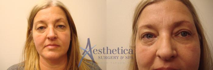 Blepharoplasty (Eyelid Surgery) Case 366 Before & After View #1 | Columbus, OH | Aesthetica Surgery & Spa