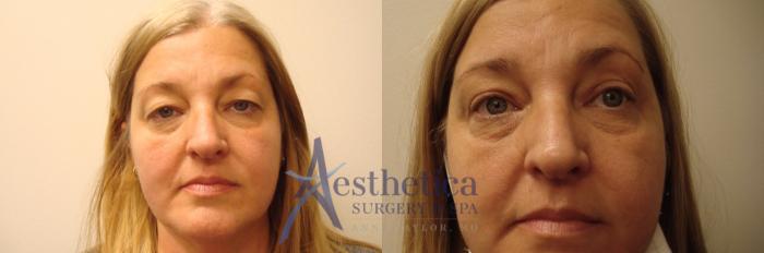Blepharoplasty (Eyelid Surgery) Case 436 Before & After Front | Columbus, OH | Aesthetica Surgery & Spa