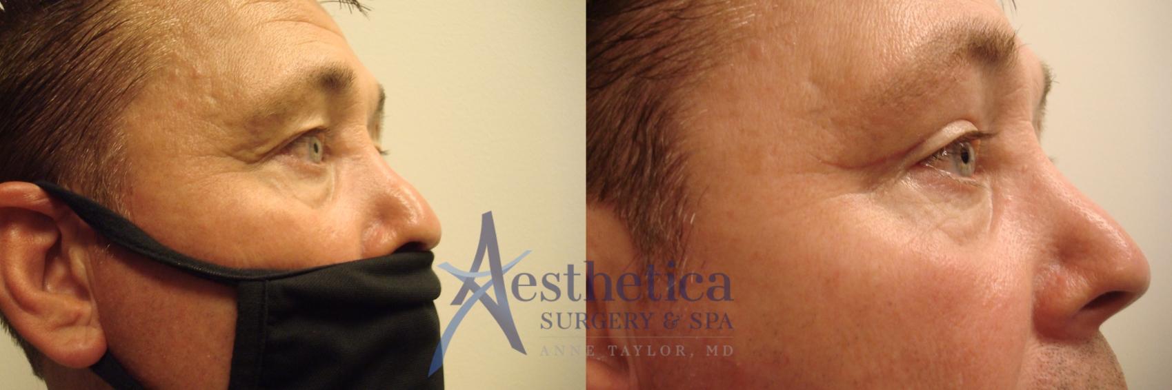 Blepharoplasty (Eyelid Surgery) Case 456 Before & After Right Side | Worthington, OH | Aesthetica Surgery & Spa