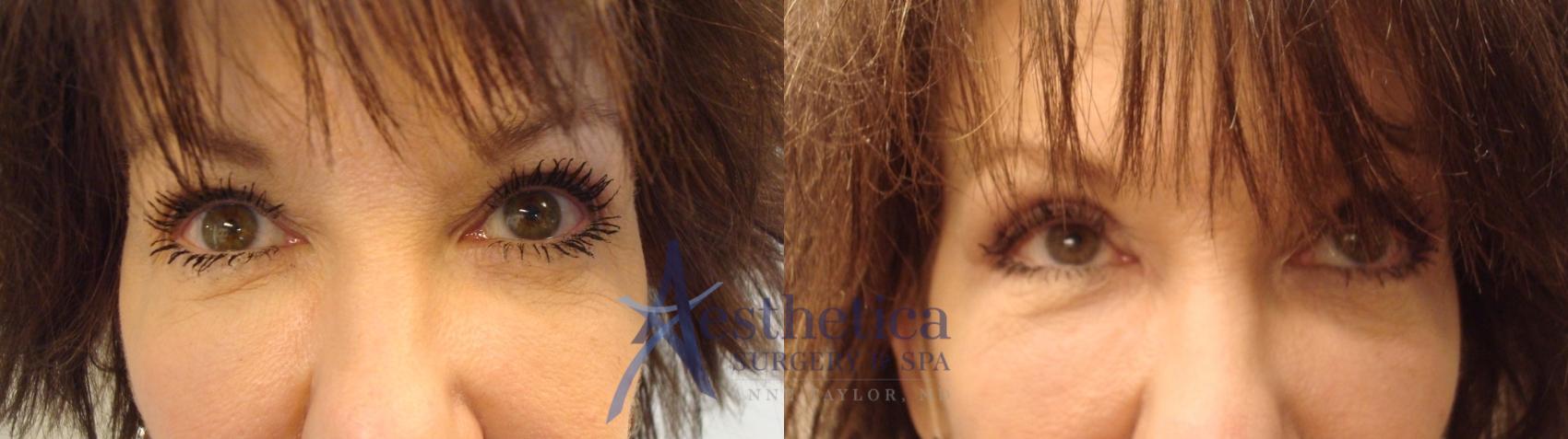 Blepharoplasty (Eyelid Surgery) Case 457 Before & After Front | Columbus, OH | Aesthetica Surgery & Spa