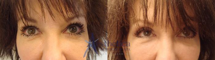 Blepharoplasty (Eyelid Surgery) Case 457 Before & After Front | Columbus, OH | Aesthetica Surgery & Spa