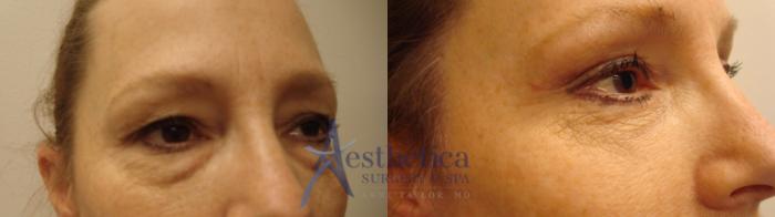 Blepharoplasty (Eyelid Surgery) Case 465 Before & After Front | Columbus, OH | Aesthetica Surgery & Spa