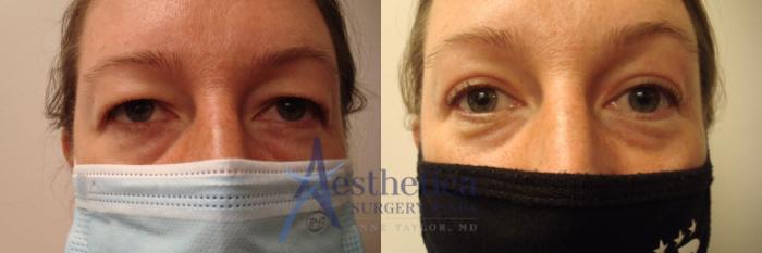 Blepharoplasty (Eyelid Surgery) Case 480 Before & After Front | Columbus, OH | Aesthetica Surgery & Spa