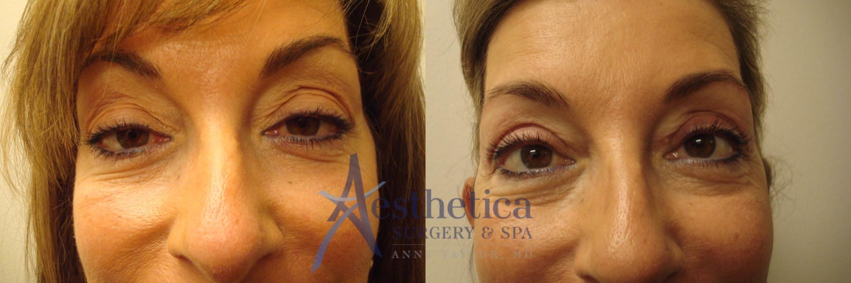Blepharoplasty (Eyelid Surgery) Case 491 Before & After Front | Columbus, OH | Aesthetica Surgery & Spa