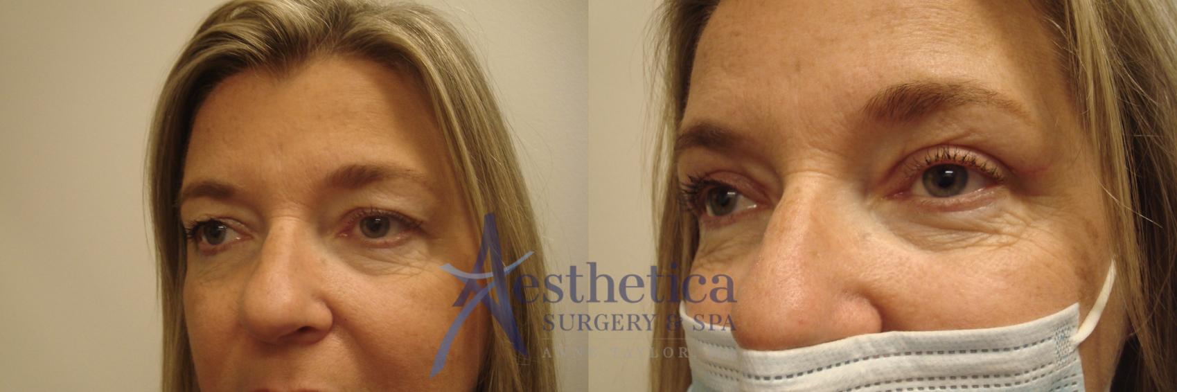 Blepharoplasty (Eyelid Surgery) Case 524 Before & After Left Oblique | Worthington, OH | Aesthetica Surgery & Spa