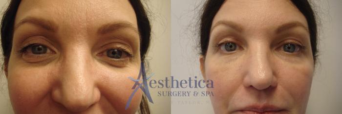 Blepharoplasty (Eyelid Surgery) Case 538 Before & After Front | Columbus, OH | Aesthetica Surgery & Spa