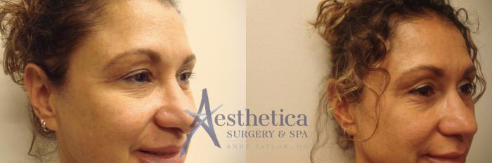 Blepharoplasty (Eyelid Surgery) Case 541 Before & After Front | Columbus, OH | Aesthetica Surgery & Spa