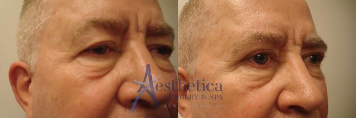 Blepharoplasty (Eyelid Surgery) Case 589 Before & After Right Side | Columbus, OH | Aesthetica Surgery & Spa