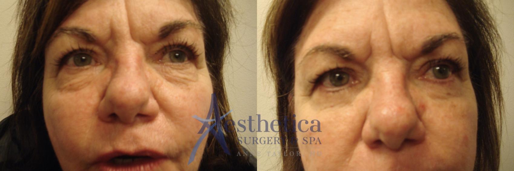 Blepharoplasty (Eyelid Surgery) Case 606 Before & After Front | Columbus, OH | Aesthetica Surgery & Spa