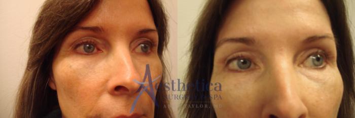 Blepharoplasty (Eyelid Surgery) Case 616 Before & After Front | Columbus, OH | Aesthetica Surgery & Spa