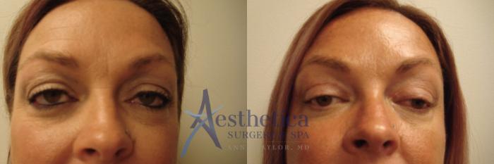 Blepharoplasty (Eyelid Surgery) Case 626 Before & After Front | Columbus, OH | Aesthetica Surgery & Spa