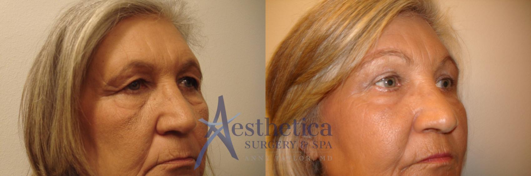 Blepharoplasty (Eyelid Surgery) Case 627 Before & After Right Oblique | Worthington, OH | Aesthetica Surgery & Spa