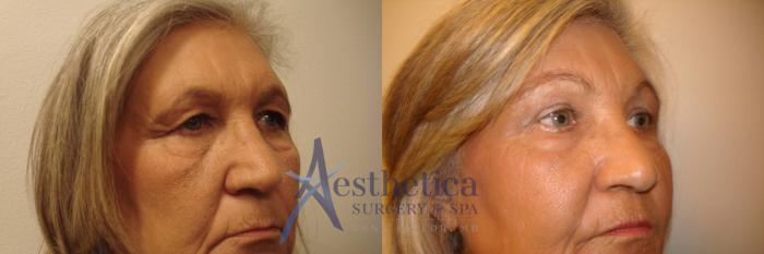 Blepharoplasty (Eyelid Surgery) Case 627 Before & After Right Oblique | Columbus, OH | Aesthetica Surgery & Spa