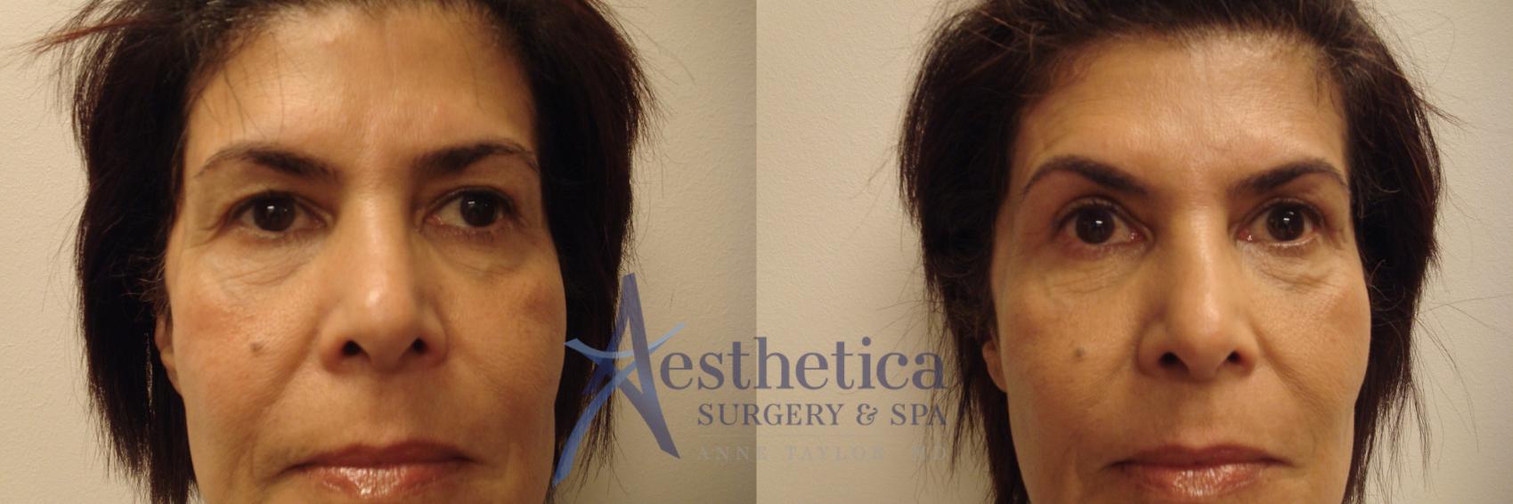 Blepharoplasty (Eyelid Surgery) Case 628 Before & After Front | Columbus, OH | Aesthetica Surgery & Spa