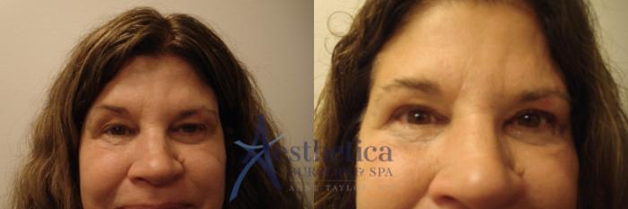 Blepharoplasty (Eyelid Surgery) Case 644 Before & After Front | Columbus, OH | Aesthetica Surgery & Spa