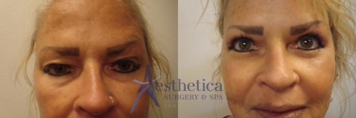 Blepharoplasty (Eyelid Surgery) Case 645 Before & After Front | Columbus, OH | Aesthetica Surgery & Spa
