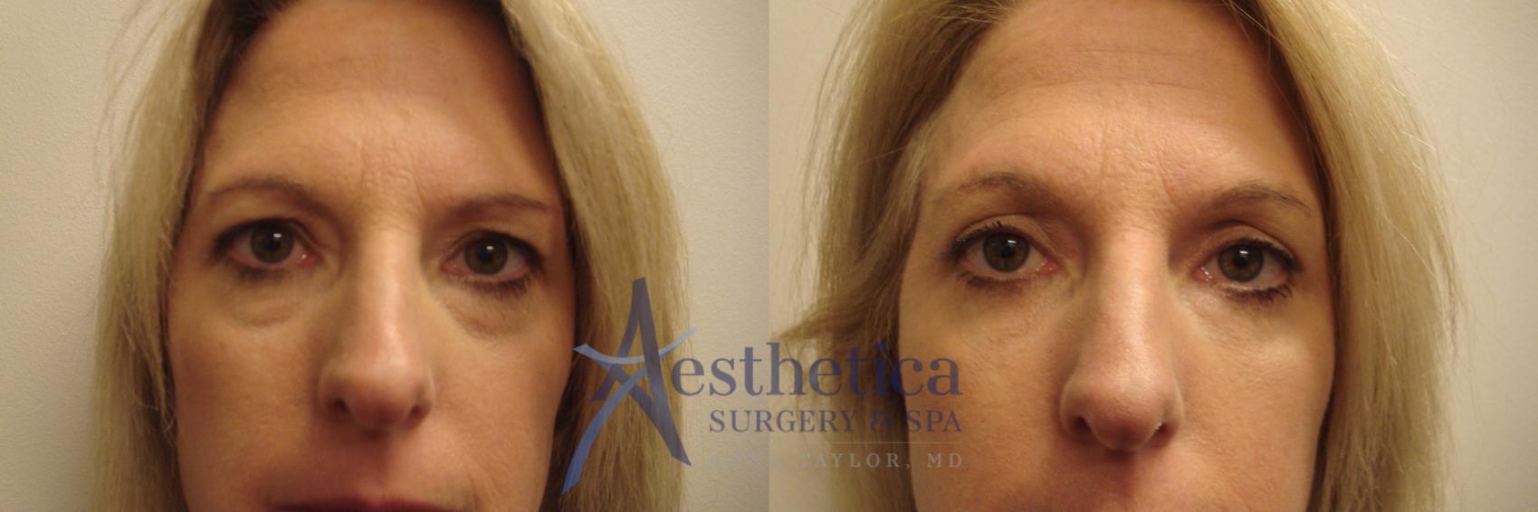 Blepharoplasty (Eyelid Surgery) Case 654 Before & After Front | Columbus, OH | Aesthetica Surgery & Spa