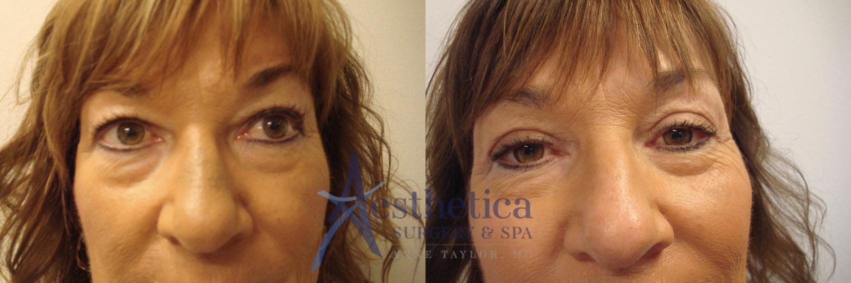 Blepharoplasty (Eyelid Surgery) Case 658 Before & After Front | Columbus, OH | Aesthetica Surgery & Spa