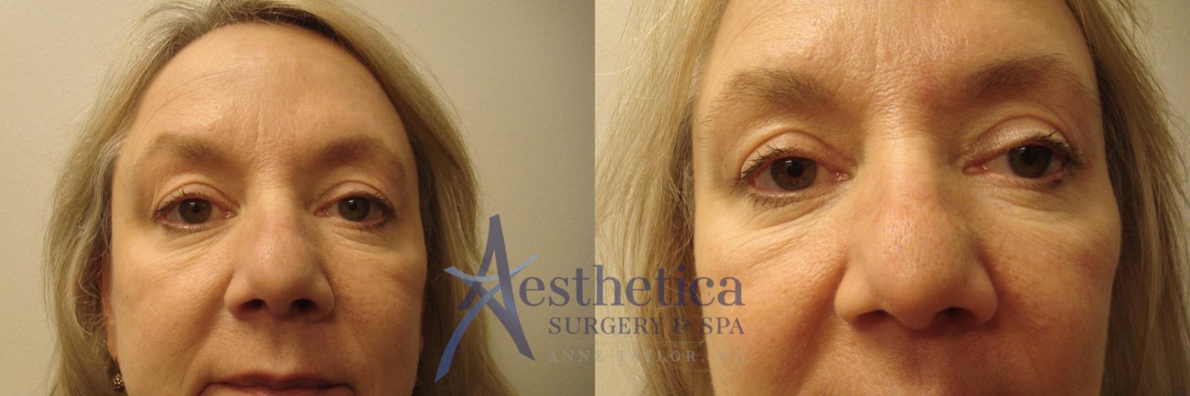 Blepharoplasty (Eyelid Surgery) Case 672 Before & After Front | Columbus, OH | Aesthetica Surgery & Spa