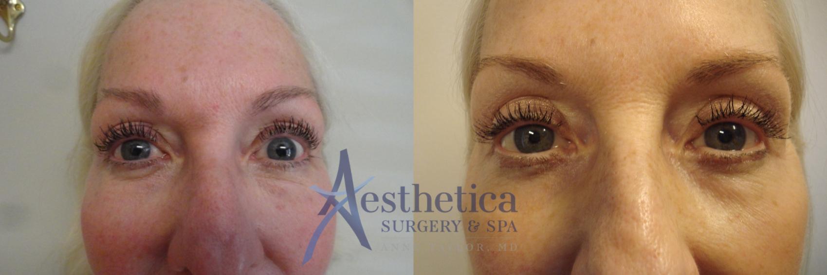 Blepharoplasty (Eyelid Surgery) Case 685 Before & After Front | Columbus, OH | Aesthetica Surgery & Spa