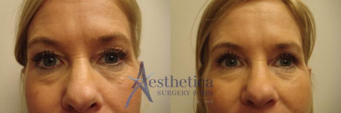 Blepharoplasty (Eyelid Surgery) Case 687 Before & After Front | Columbus, OH | Aesthetica Surgery & Spa