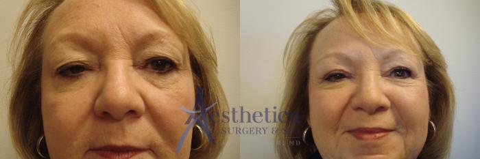 Blepharoplasty (Eyelid Surgery) Case 688 Before & After Front | Columbus, OH | Aesthetica Surgery & Spa