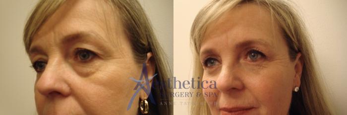 Blepharoplasty (Eyelid Surgery) Case 711 Before & After Left Oblique | Columbus, OH | Aesthetica Surgery & Spa