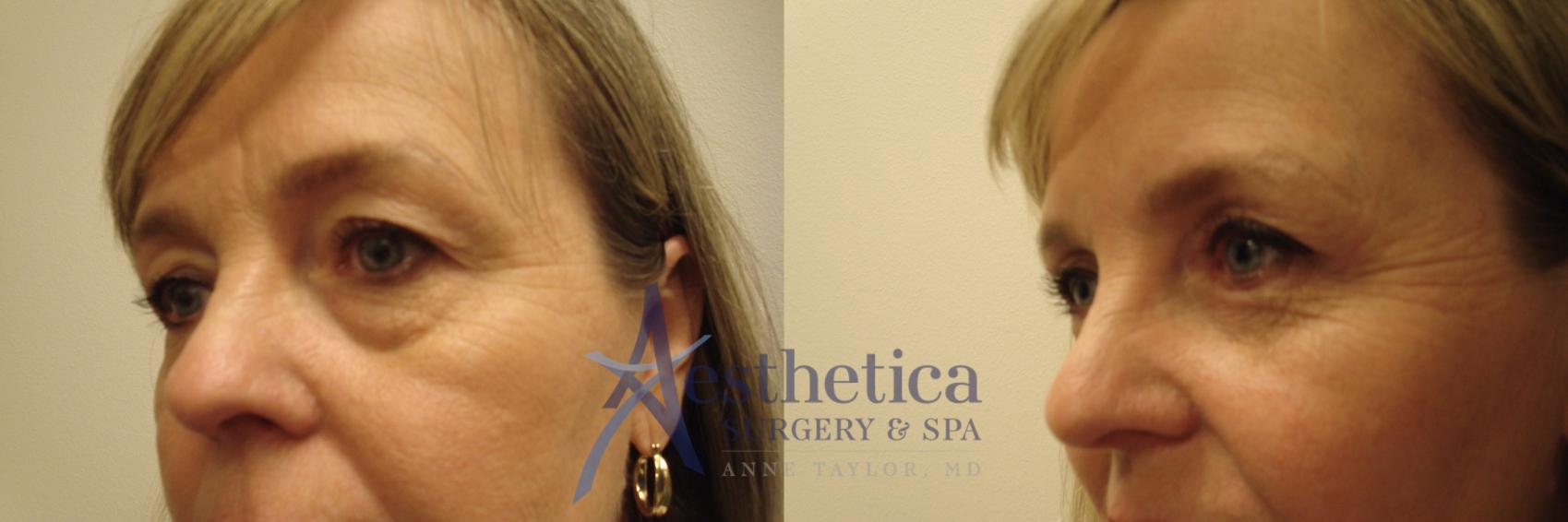Blepharoplasty (Eyelid Surgery) Case 712 Before & After Right Oblique | Columbus, OH | Aesthetica Surgery & Spa