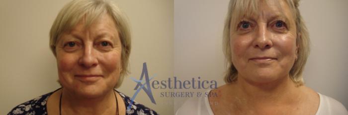 Blepharoplasty (Eyelid Surgery) Case 730 Before & After Front | Columbus, OH | Aesthetica Surgery & Spa