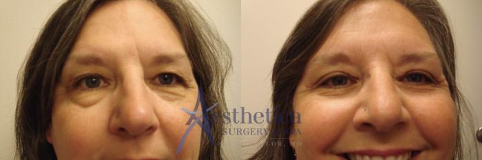 Blepharoplasty (Eyelid Surgery) Case 737 Before & After Front | Columbus, OH | Aesthetica Surgery & Spa
