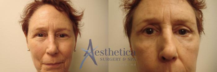 Blepharoplasty (Eyelid Surgery) Case 738 Before & After Front | Columbus, OH | Aesthetica Surgery & Spa