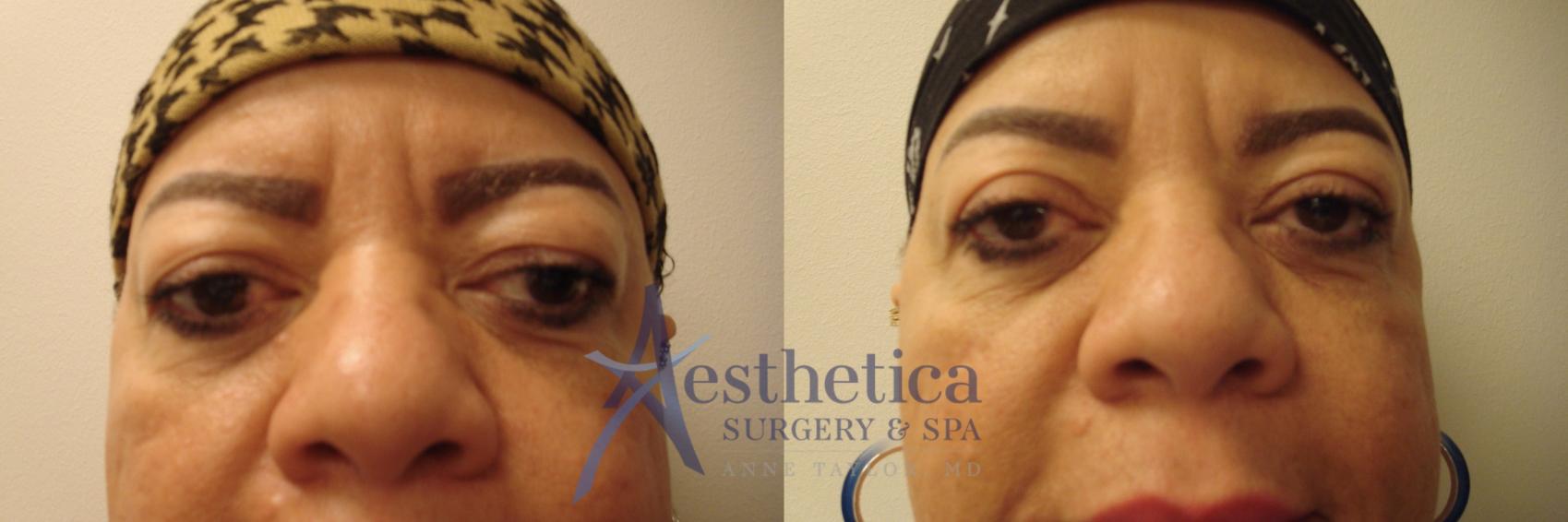 Blepharoplasty (Eyelid Surgery) Case 740 Before & After Front | Columbus, OH | Aesthetica Surgery & Spa