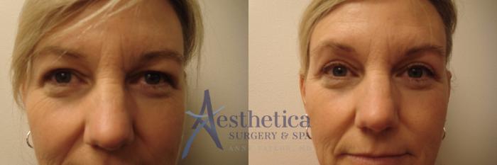 Blepharoplasty (Eyelid Surgery) Case 751 Before & After Front | Columbus, OH | Aesthetica Surgery & Spa