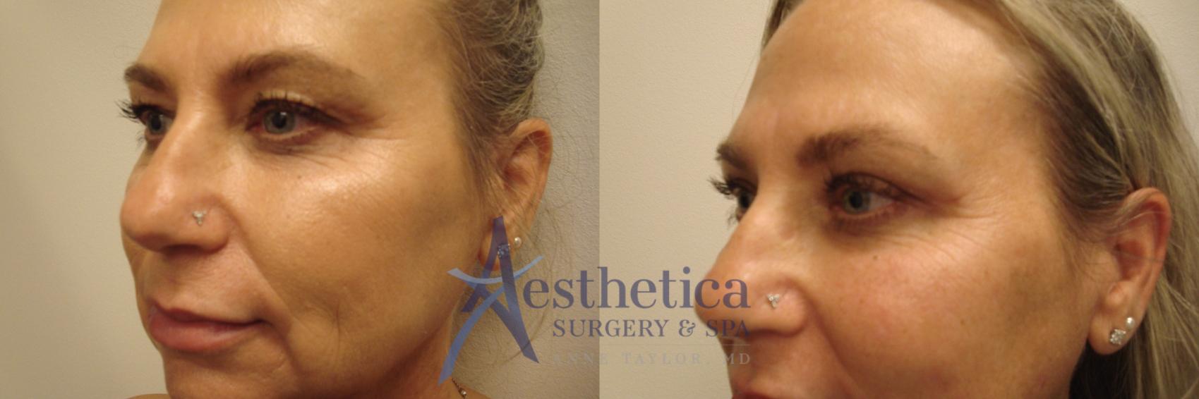 Blepharoplasty (Eyelid Surgery) Case 754 Before & After Left Side | Columbus, OH | Aesthetica Surgery & Spa