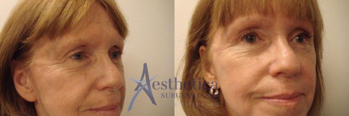 Blepharoplasty (Eyelid Surgery) Case 759 Before & After Right Oblique | Columbus, OH | Aesthetica Surgery & Spa