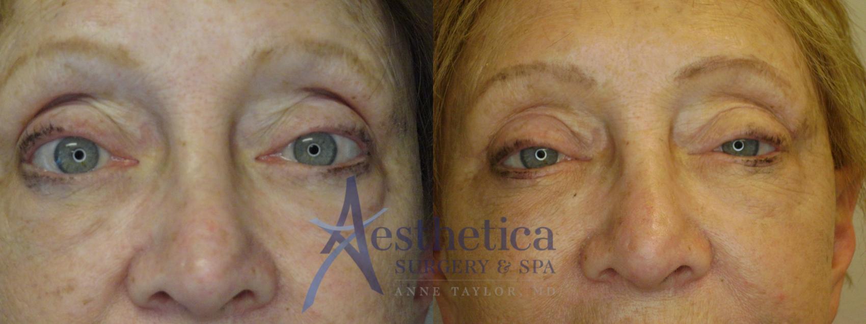 Blepharoplasty (Eyelid Surgery) Case 781 Before & After Front | Columbus, OH | Aesthetica Surgery & Spa